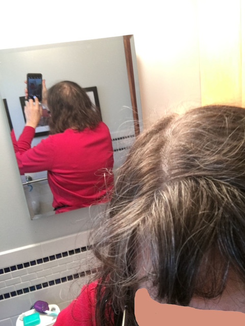 Breast Cancer Topic Cold Cap Before And After Photos