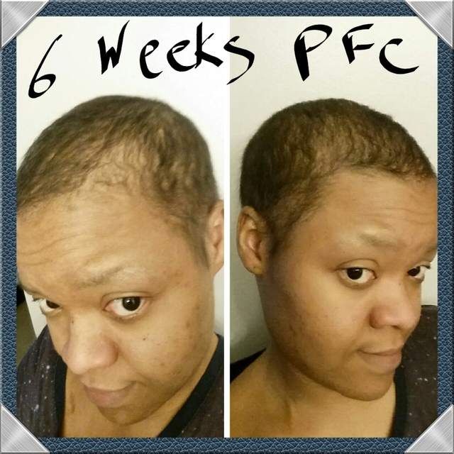 Breast Cancer Topic Hair Regrowth Timeline